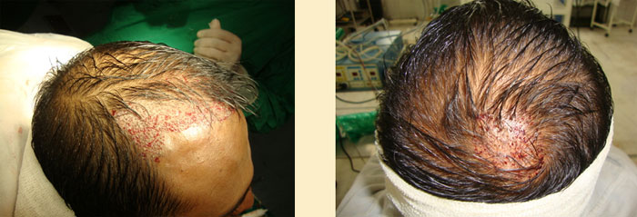 Hair Transplant done in Mumbai