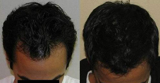 Hair Transplant done in Agra