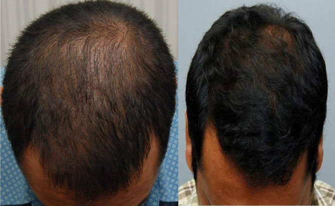 Hair Transplant before and after photos