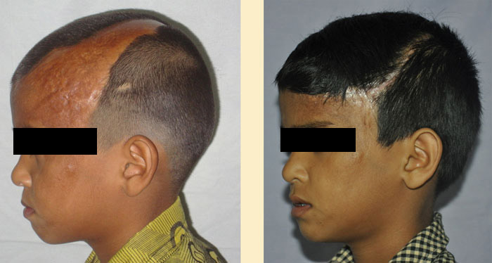 Hair Transplantation before and after