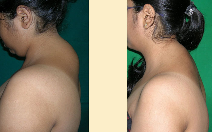 Dorsal Hump Surgery Mumbai