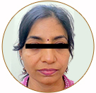 Eyelid Correction done by Dr Arunesh Gupta