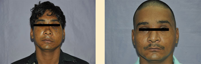 Facial Trauma treatment in Agra