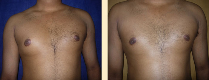 Gynecomastia treatment in Mumbai