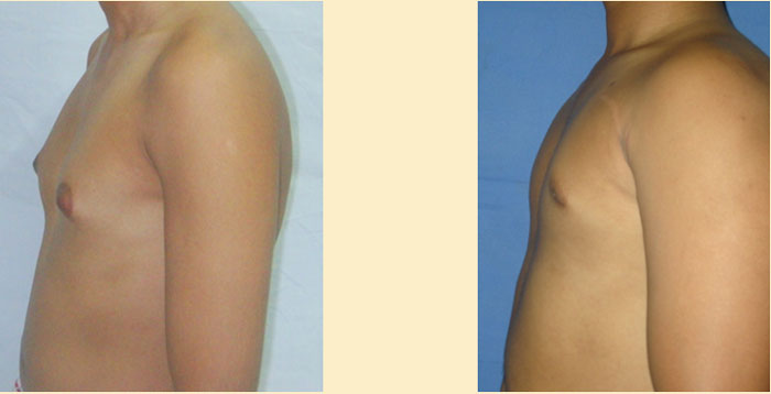 Gynecomastia surgery in Mumbai