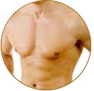 Surgery for Gynecomastia in Agra or Mumbai