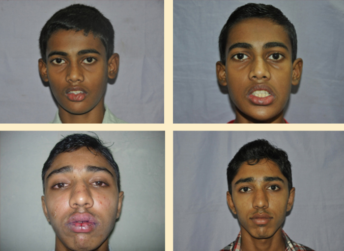 Lip Reduction procedure in Mumbai
