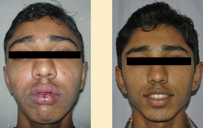 Lip Reduction before and after