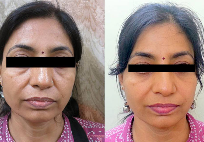 Eyelid correction in Mumbai