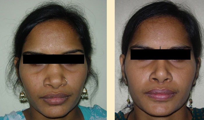 Nose Job done in Mumbai, Maharashtra